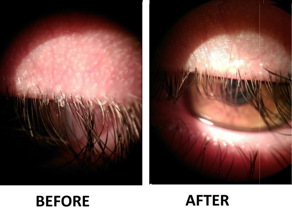 Demodex (mite) infestation of the lashes 