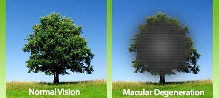 Macular-Degeneration